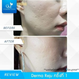รีวิว Derma Reju by charmer clinic
