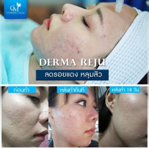 รีวิว Derma Reju by charmer clinic