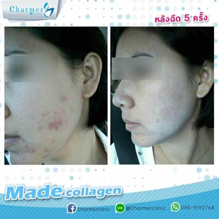 รีวิวฉีด made collagen