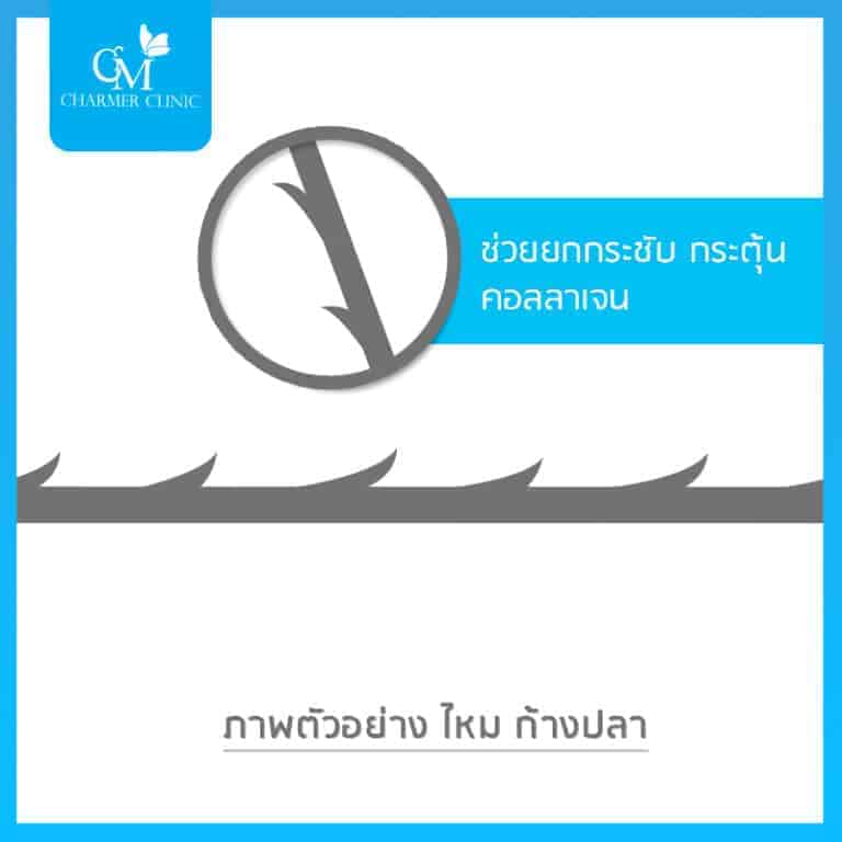 ตัวอย่างไหมก้างปลา by charmer clinic