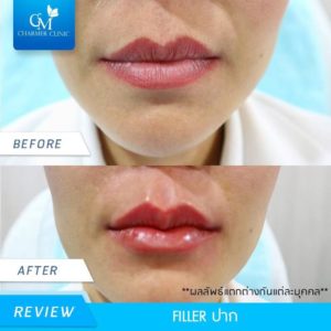 รีวิว filler ปาก by charmer clinic