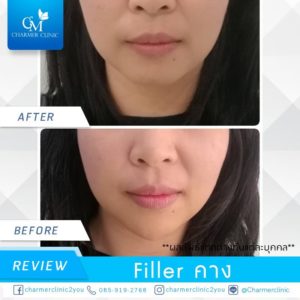 รีวิว filler คาง by charmer clinic