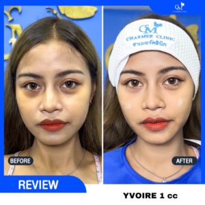 รีวิวฟิลเลอร์ใต้ตา yvoire อีโวร์