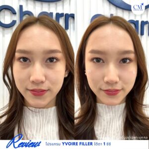 รีวิวโปรแกรมฟิลเลอร์ใต้ตา