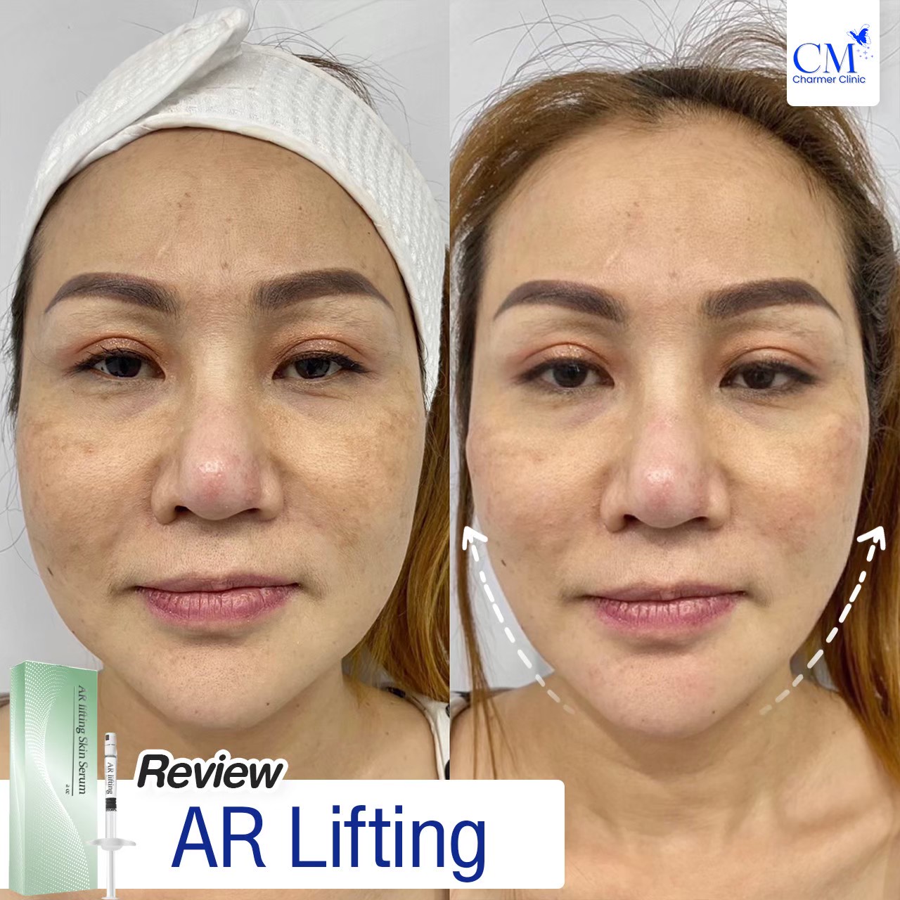 รีวิว AR Lifting