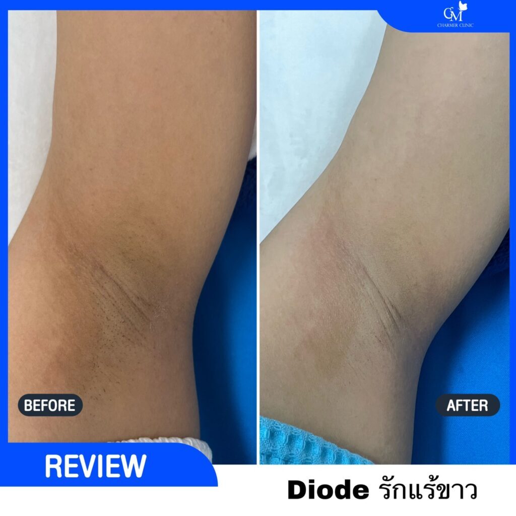 Diode laser ไดโอด