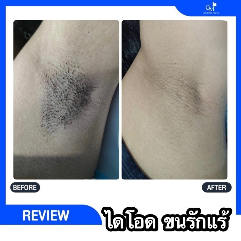 Diode laser ไดโอด