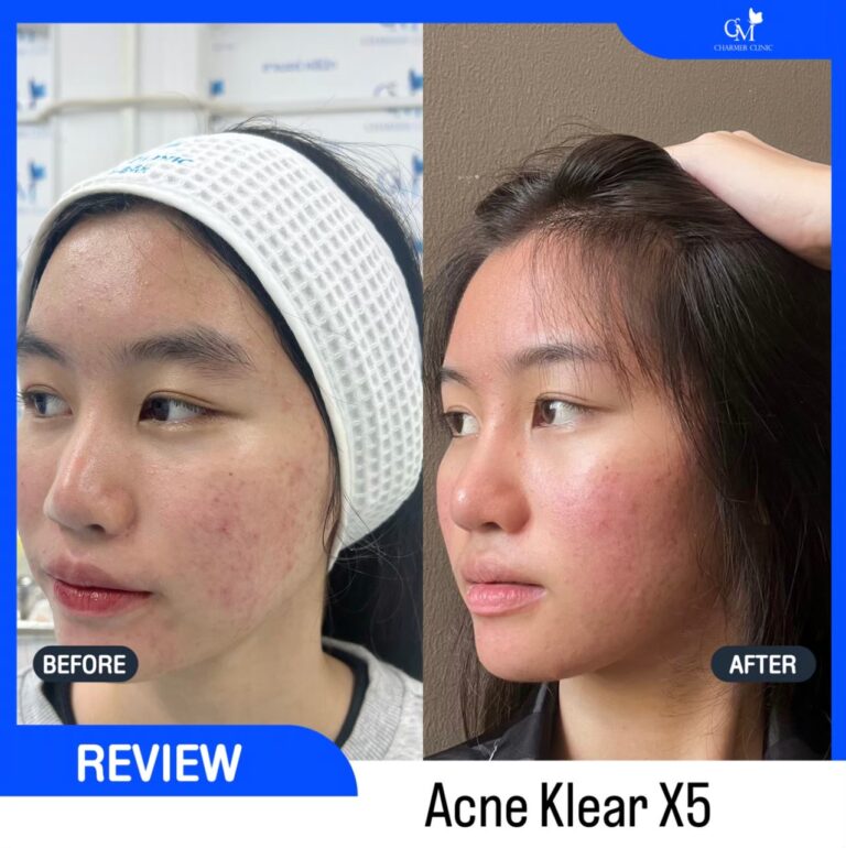 charmer clinic รีวิวเมโสลดสิว acne klear x5